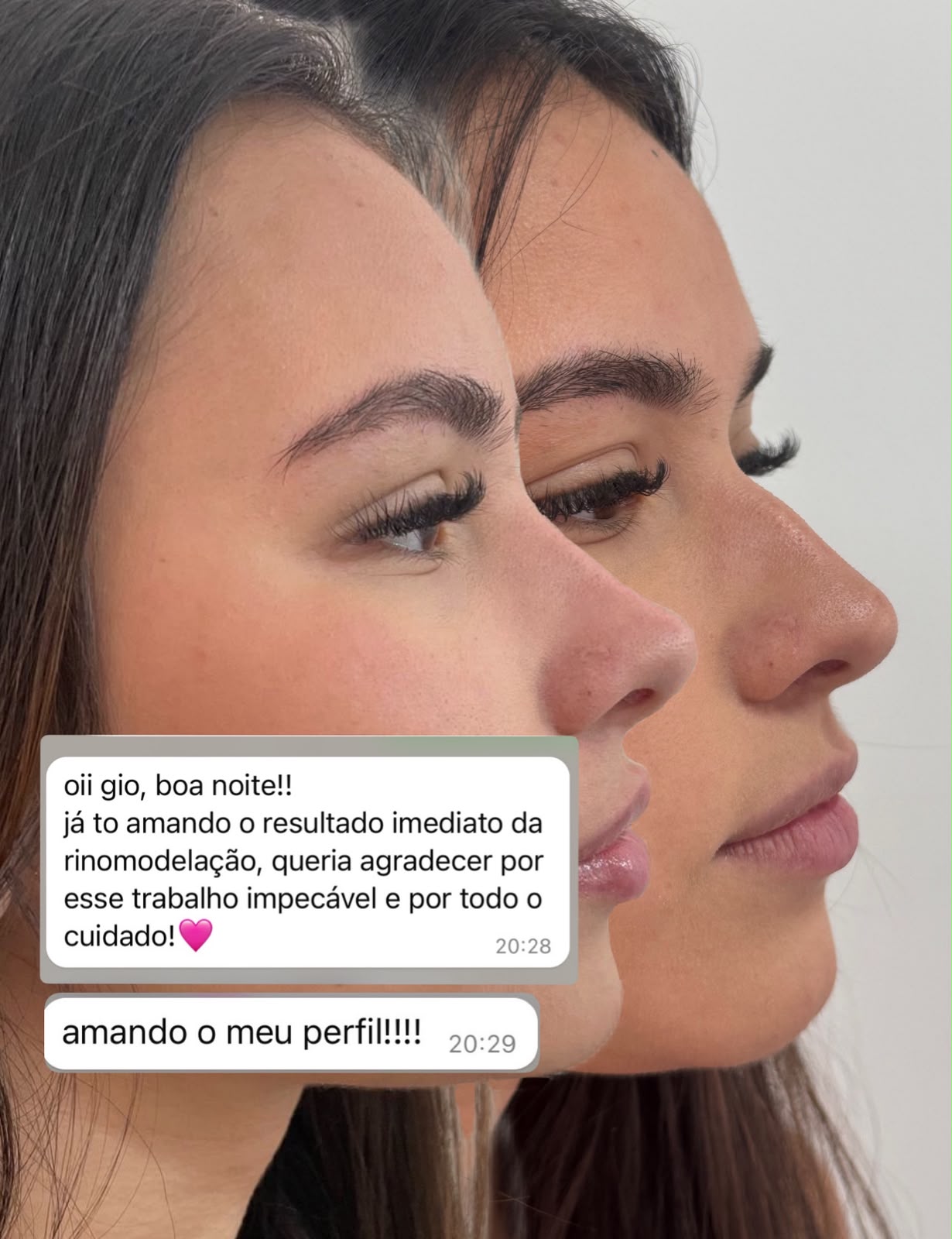 Comparação de perfil com mensagem da paciente agradecendo pelo resultado da rinomodelação e pelo cuidado