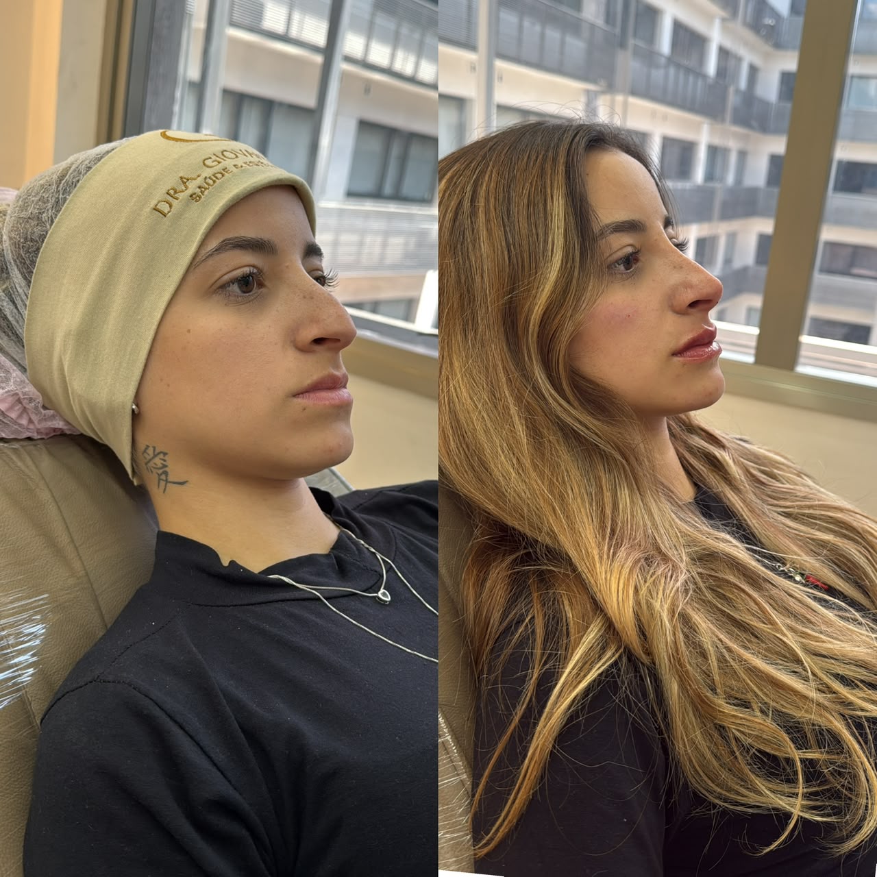 Comparação lateral antes e depois de Perfil UP